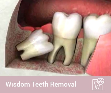 wisdom teeth removal aspendale
