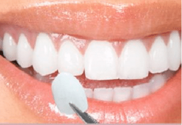 Crowns and Veneers