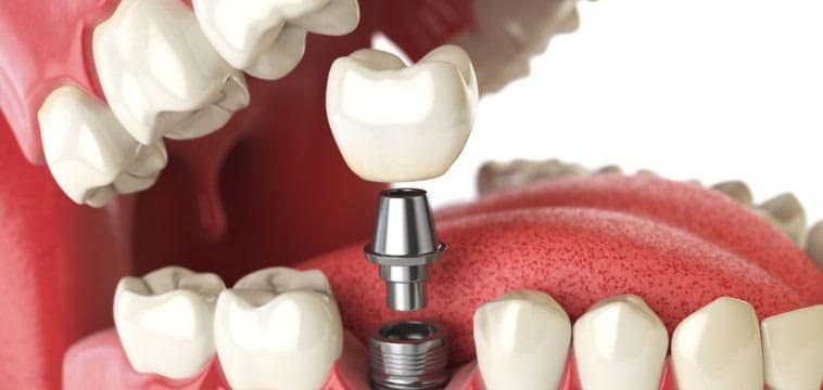 dental implant